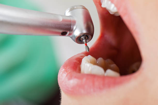 Best Emergency Tooth Extraction in Kempner, TX